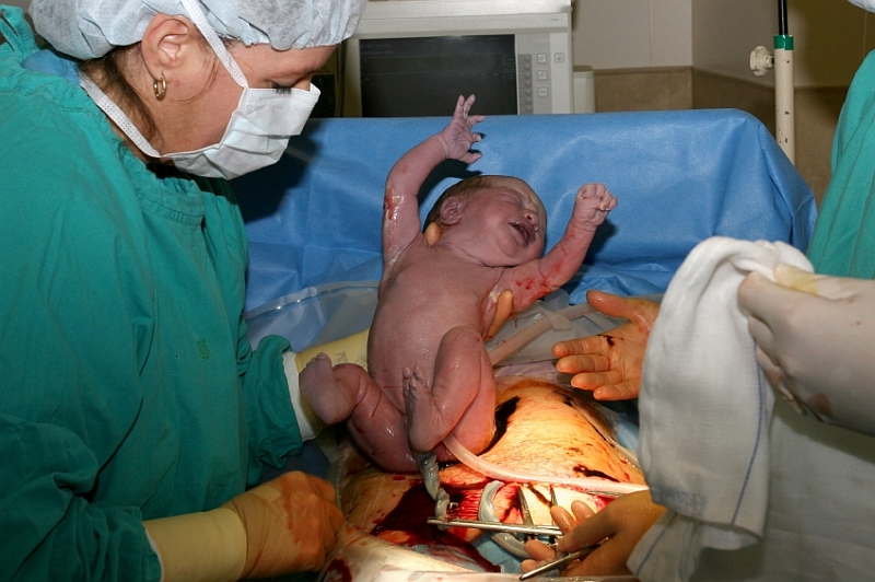 Fotografie (Komplikácie pri pôrode nemusia nevyhnutne viesť k cisárskemu rezu)